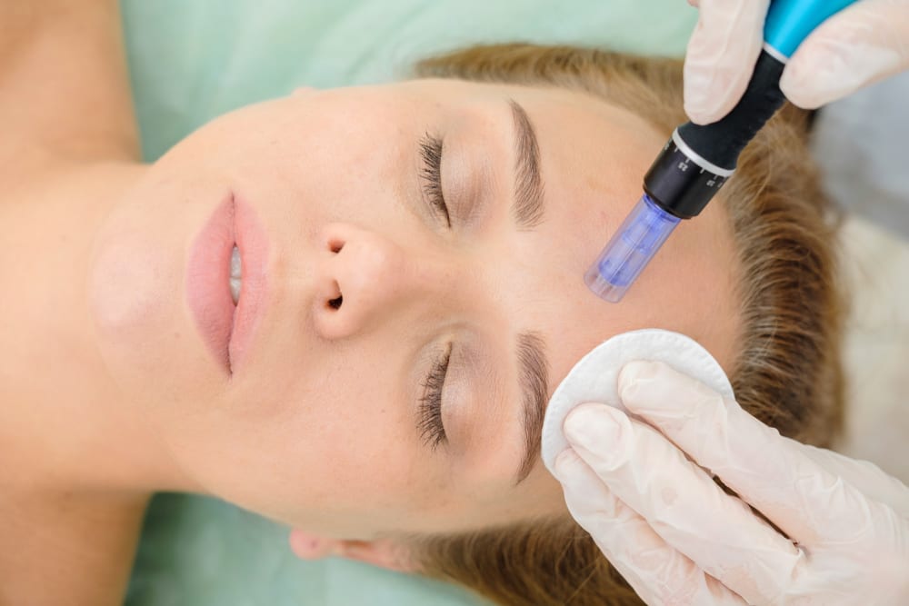 5 Surprising Microneedling Benefits For Your Skin A New You Aesthetics